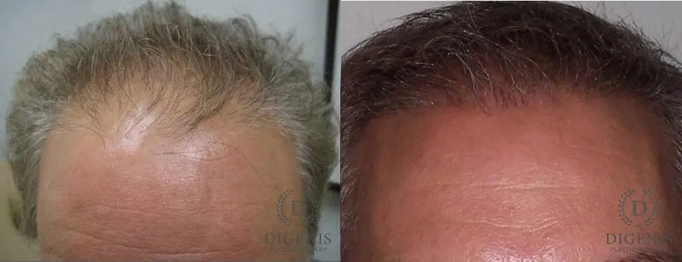 NeoGraft Hair Restoration: Patient 1 - Before and After 1