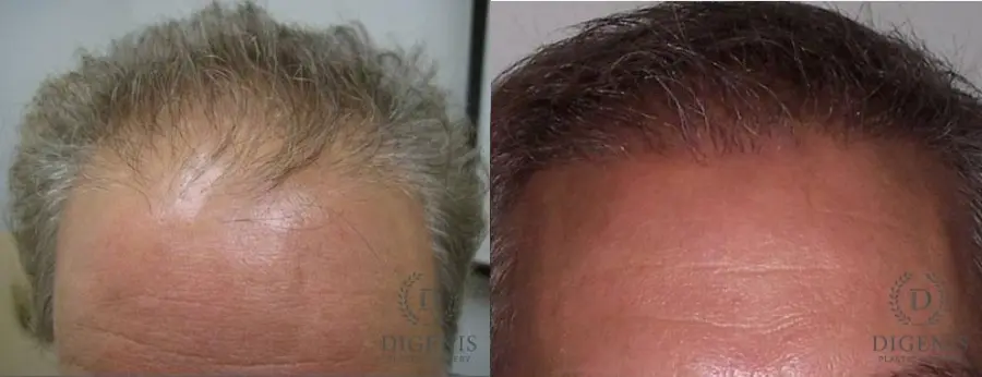 NeoGraft Hair Restoration: Patient 1 - Before and After  