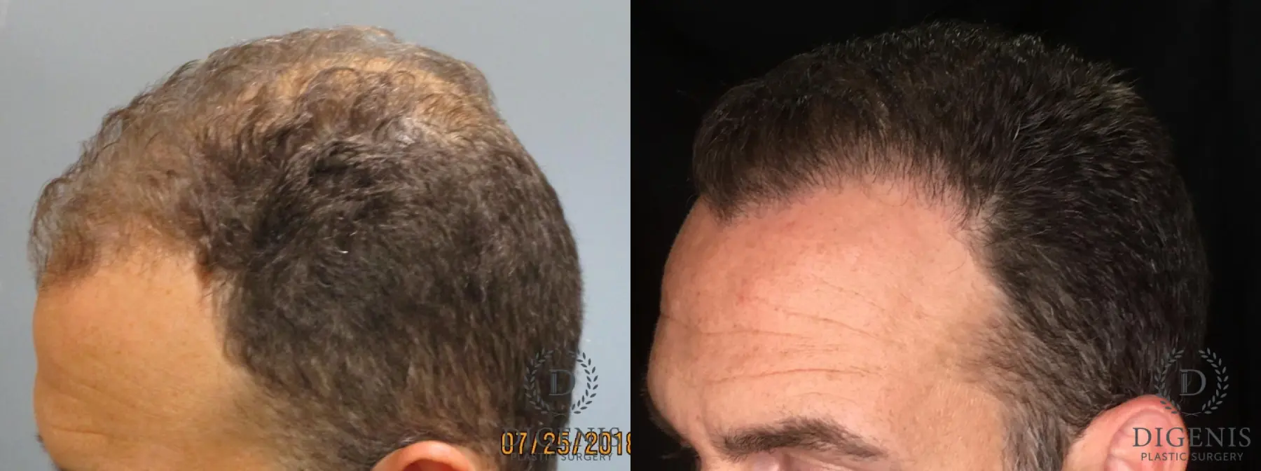NeoGraft Hair Restoration: Patient 2 - Before and After 1