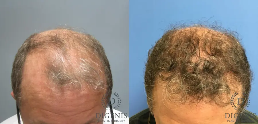 NeoGraft Hair Restoration: Patient 3 - Before and After 1