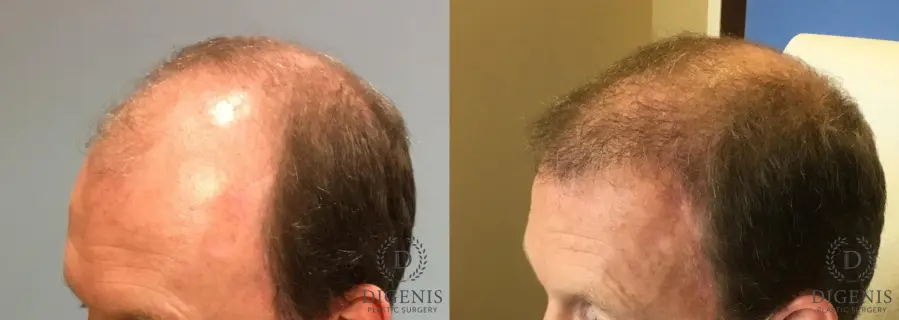 NeoGraft Hair Restoration: Patient 4 - Before and After 2