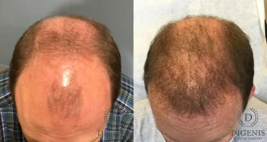 NeoGraft Hair Restoration: Patient 4 - Before and After 1