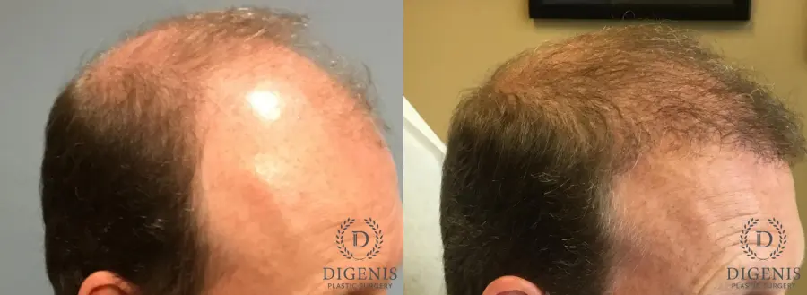 NeoGraft Hair Restoration: Patient 4 - Before and After 3
