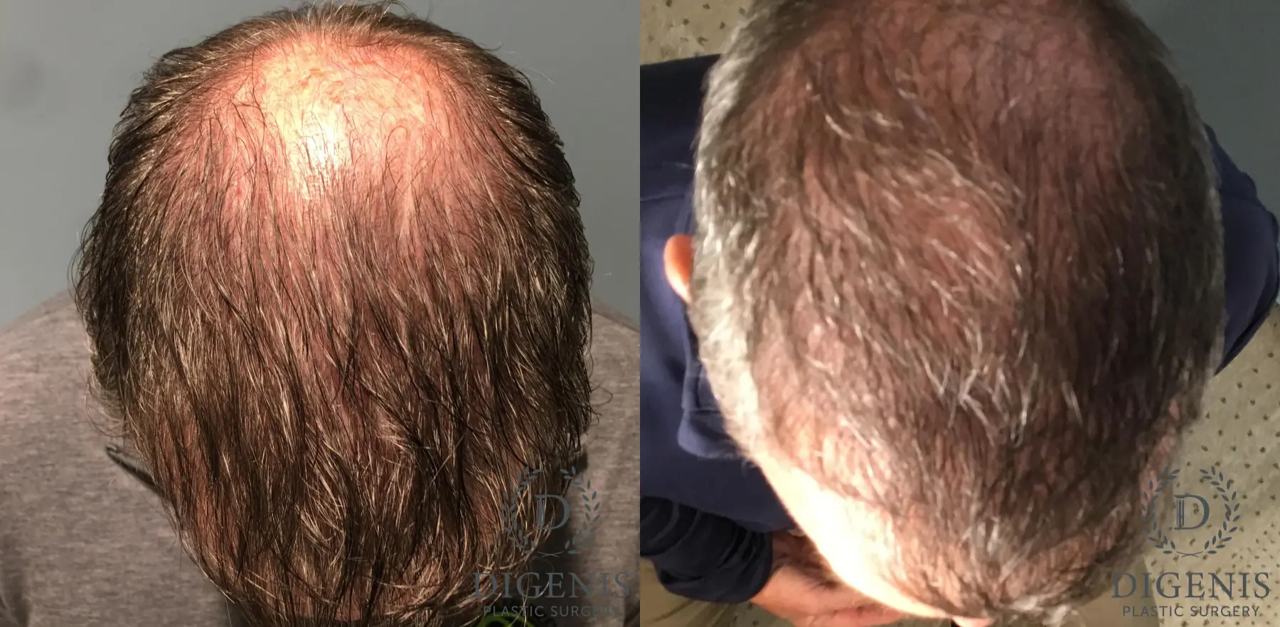 NeoGraft Hair Restoration: Patient 2 - Before and After  