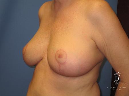 Breast Lift: Patient 6 - After 4