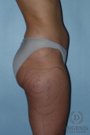 Liposuction: Patient 3 - Before 3