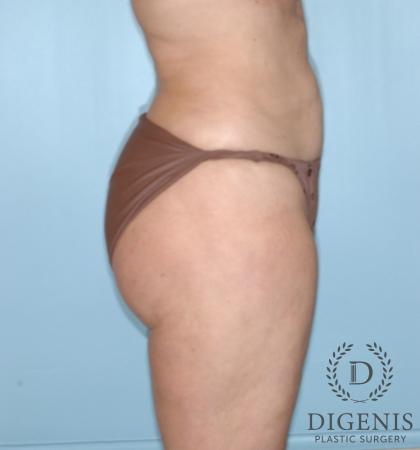 Liposuction: Patient 4 - After 3