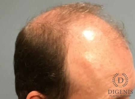 NeoGraft Hair Restoration: Patient 4 - Before and After 3