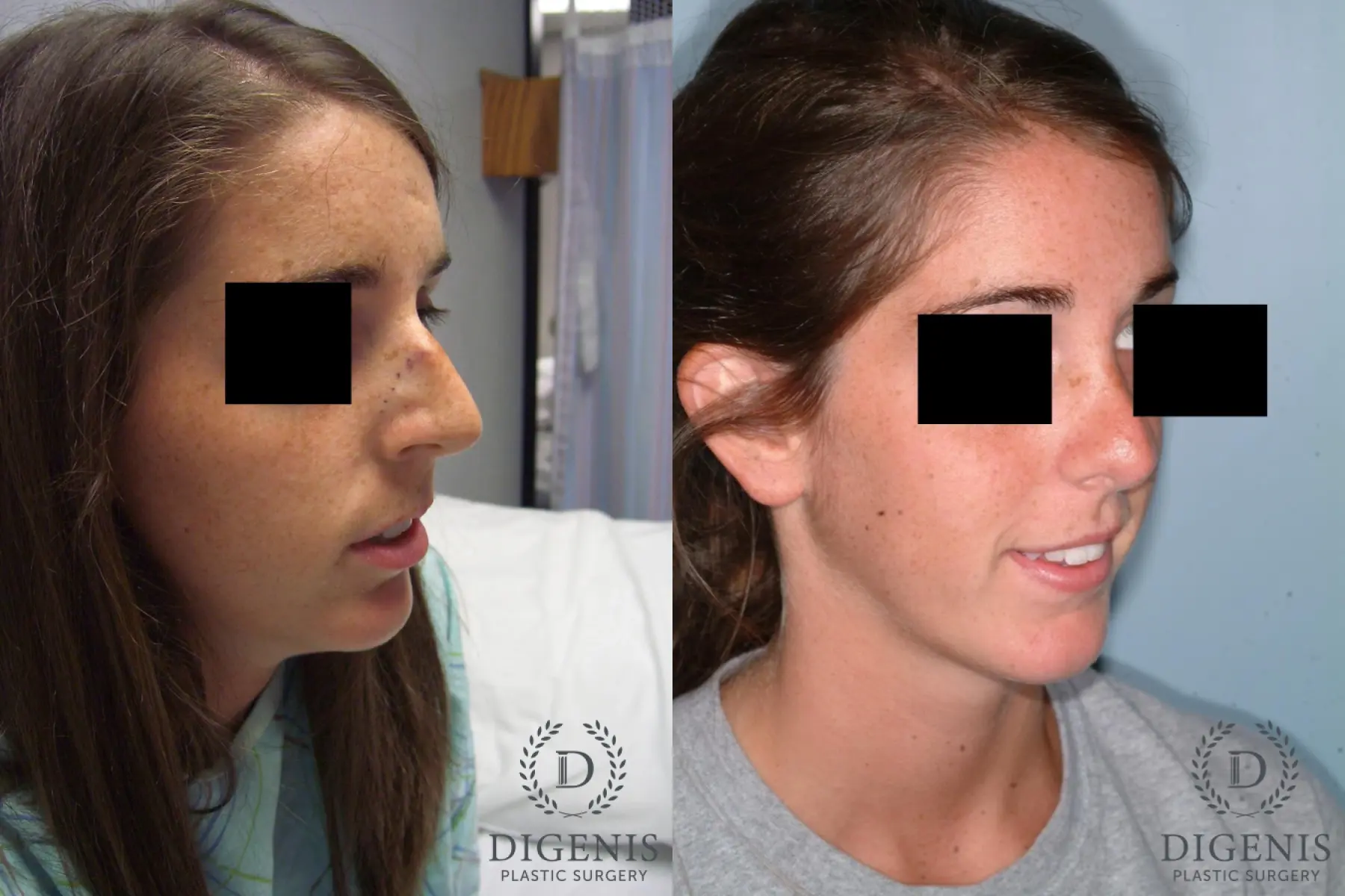 Rhinoplasty: Patient 6 - Before and After 2