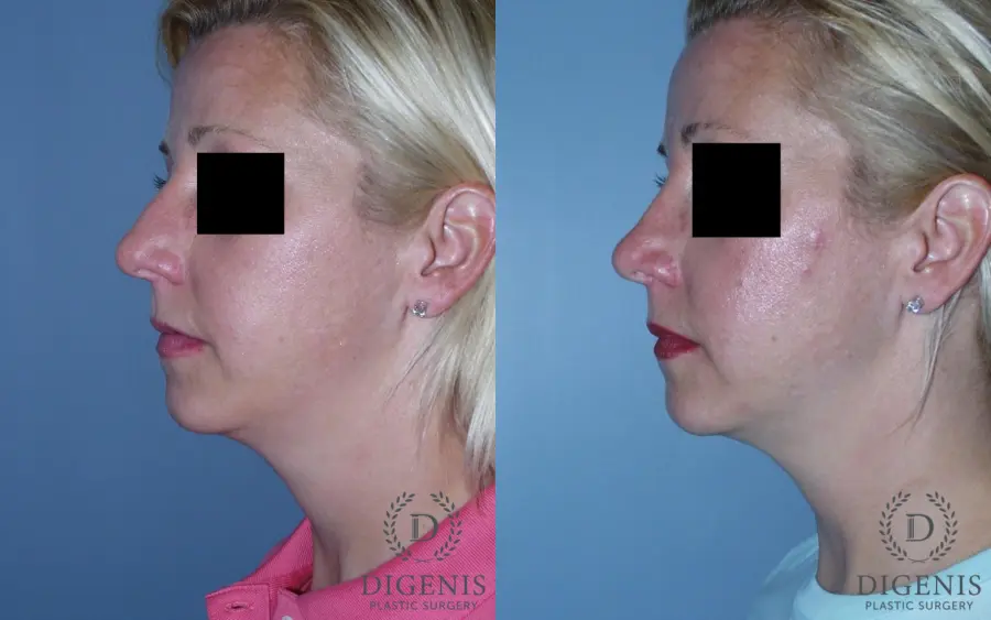 Rhinoplasty: Patient 3 - Before and After 5