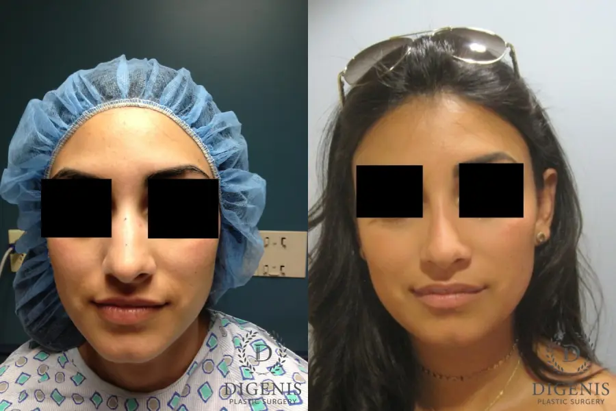 Rhinoplasty: Patient 7 - Before and After 1