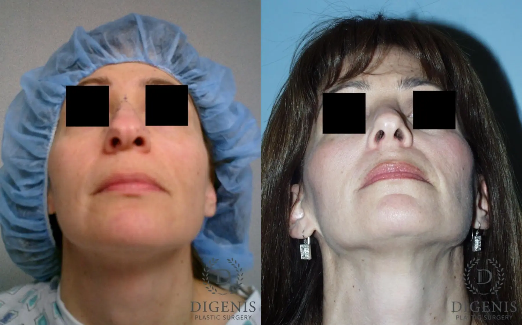 Rhinoplasty: Patient 5 - Before and After 6