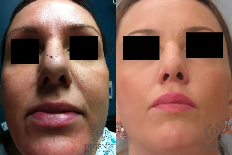 Rhinoplasty: Patient 1 - Before and After 2