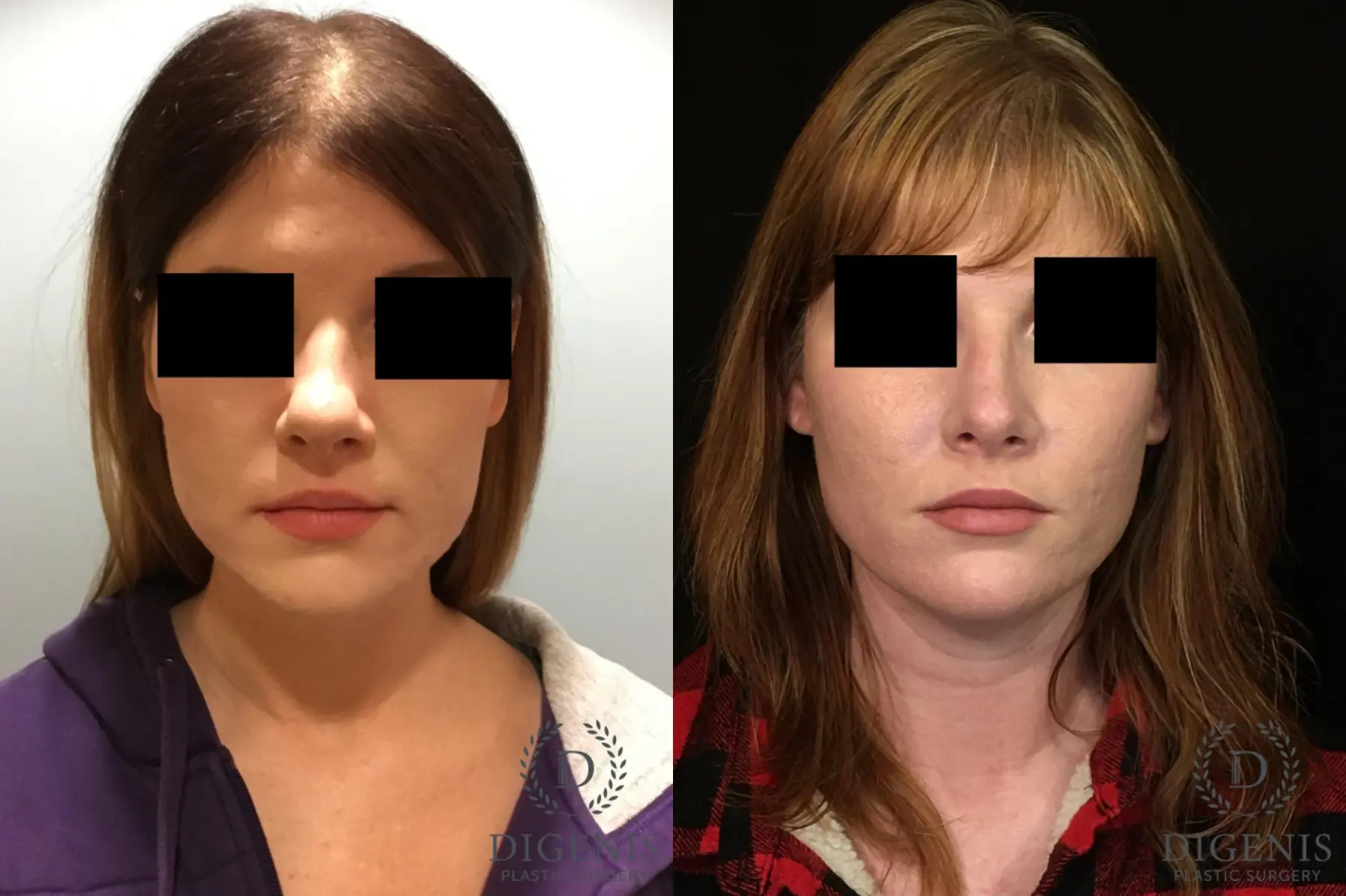 Rhinoplasty: Patient 2 - Before and After  