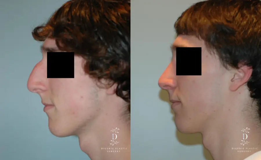 Rhinoplasty: Patient 9 - Before and After 5