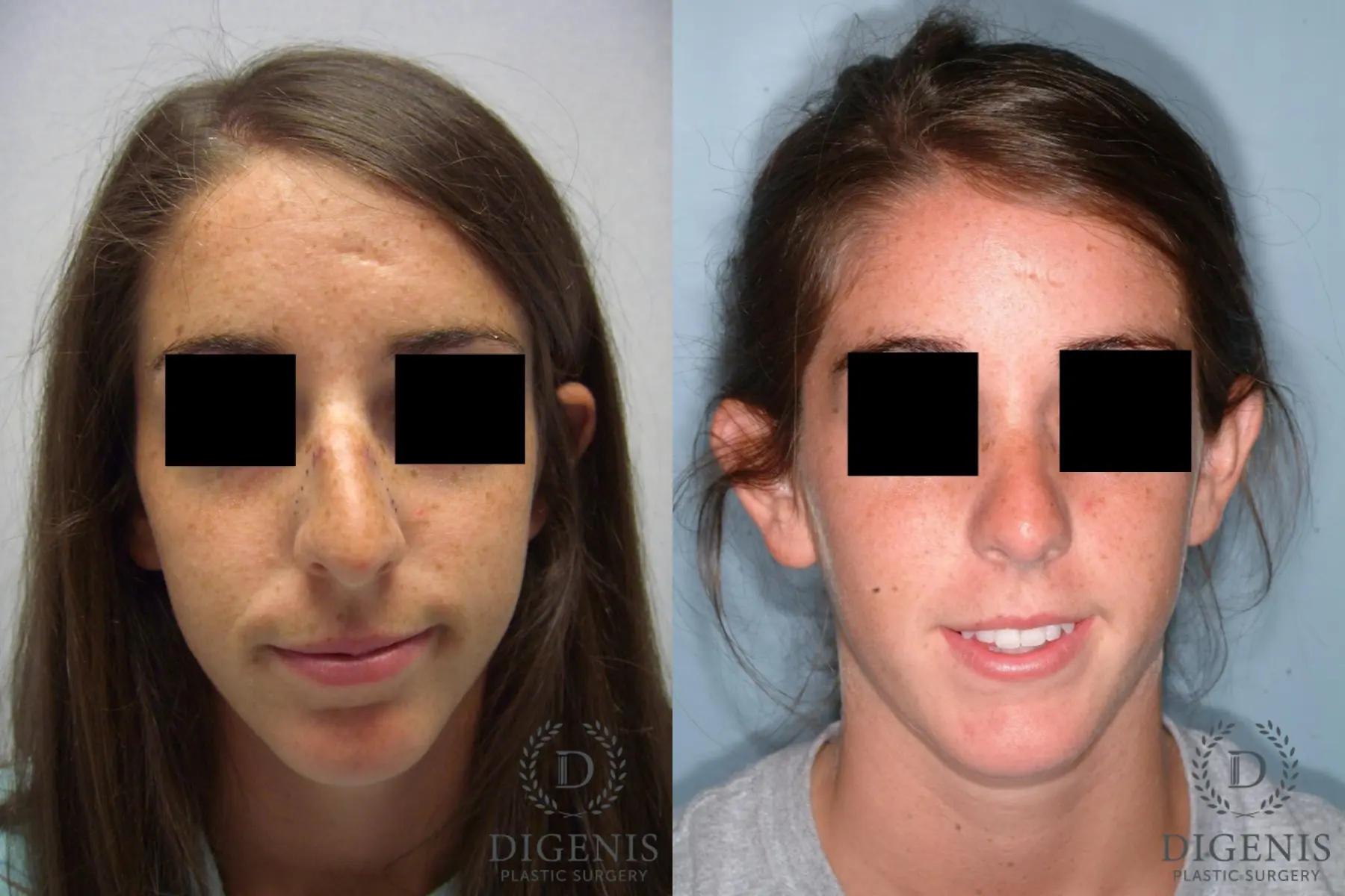 Rhinoplasty: Patient 6 - Before and After  