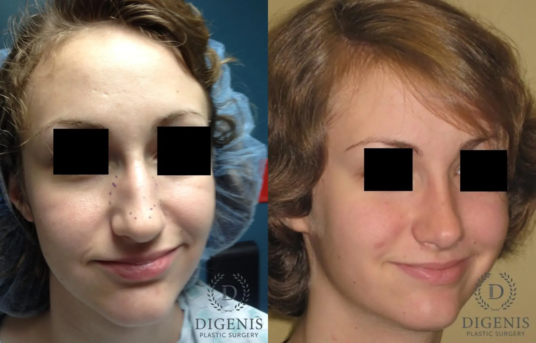 Rhinoplasty: Patient 4 - Before and After  