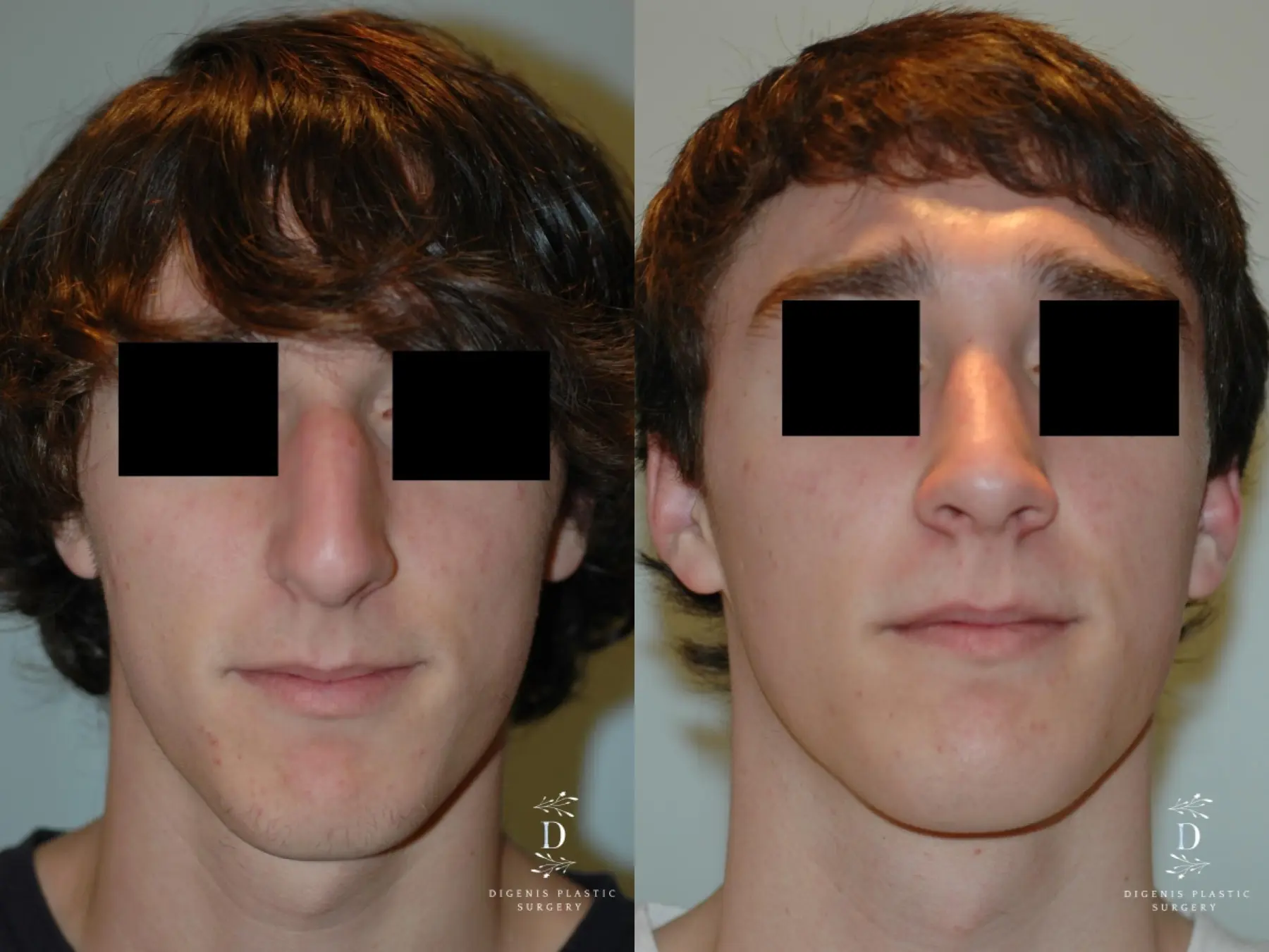 Rhinoplasty: Patient 9 - Before and After  