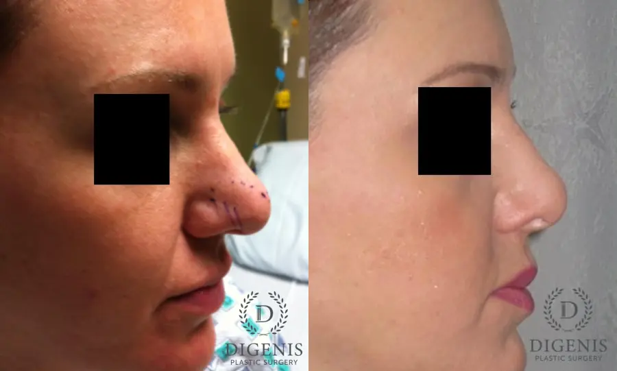 Rhinoplasty: Patient 1 - Before and After 3