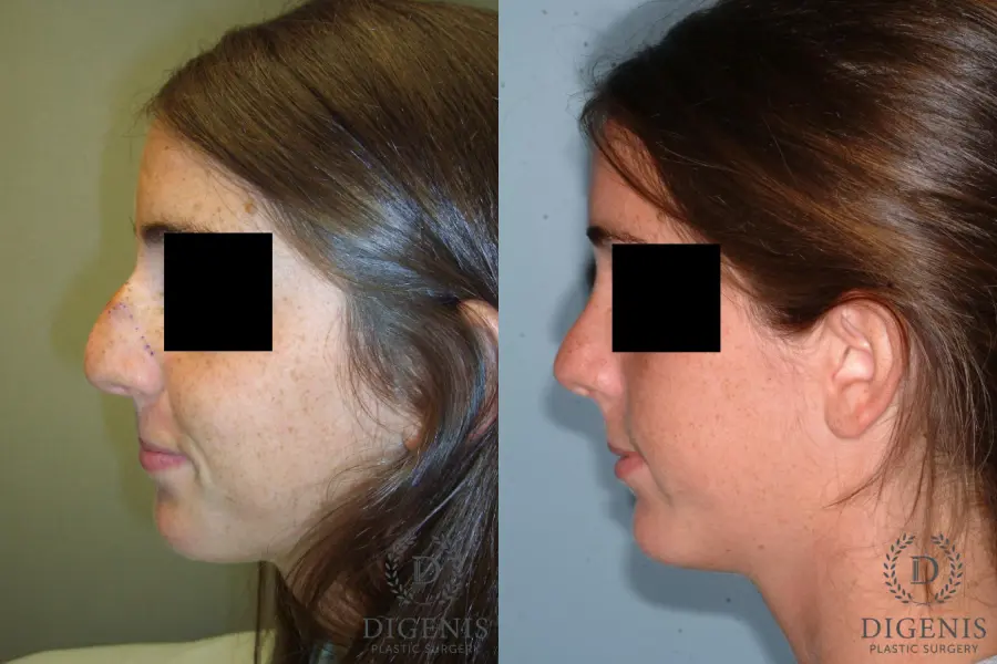 Rhinoplasty: Patient 6 - Before and After 4