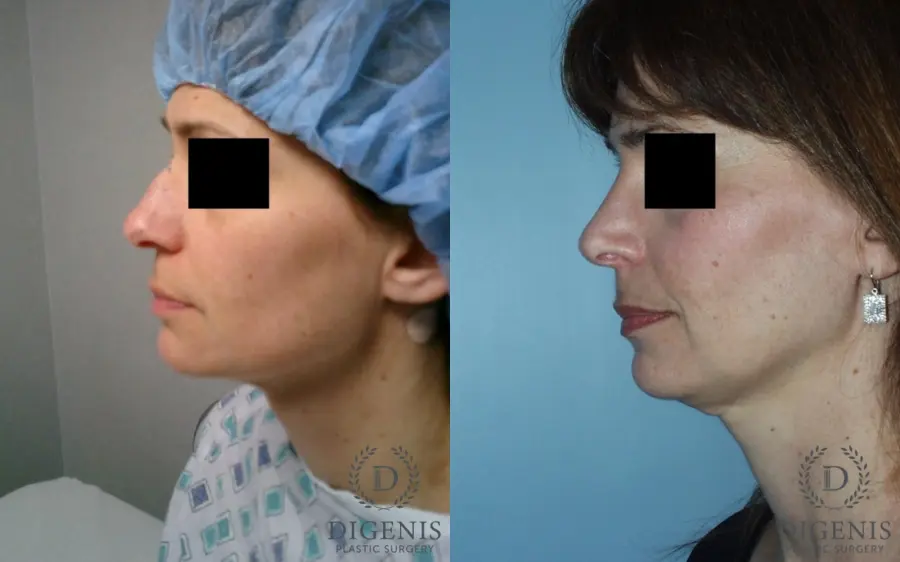 Rhinoplasty: Patient 5 - Before and After 5