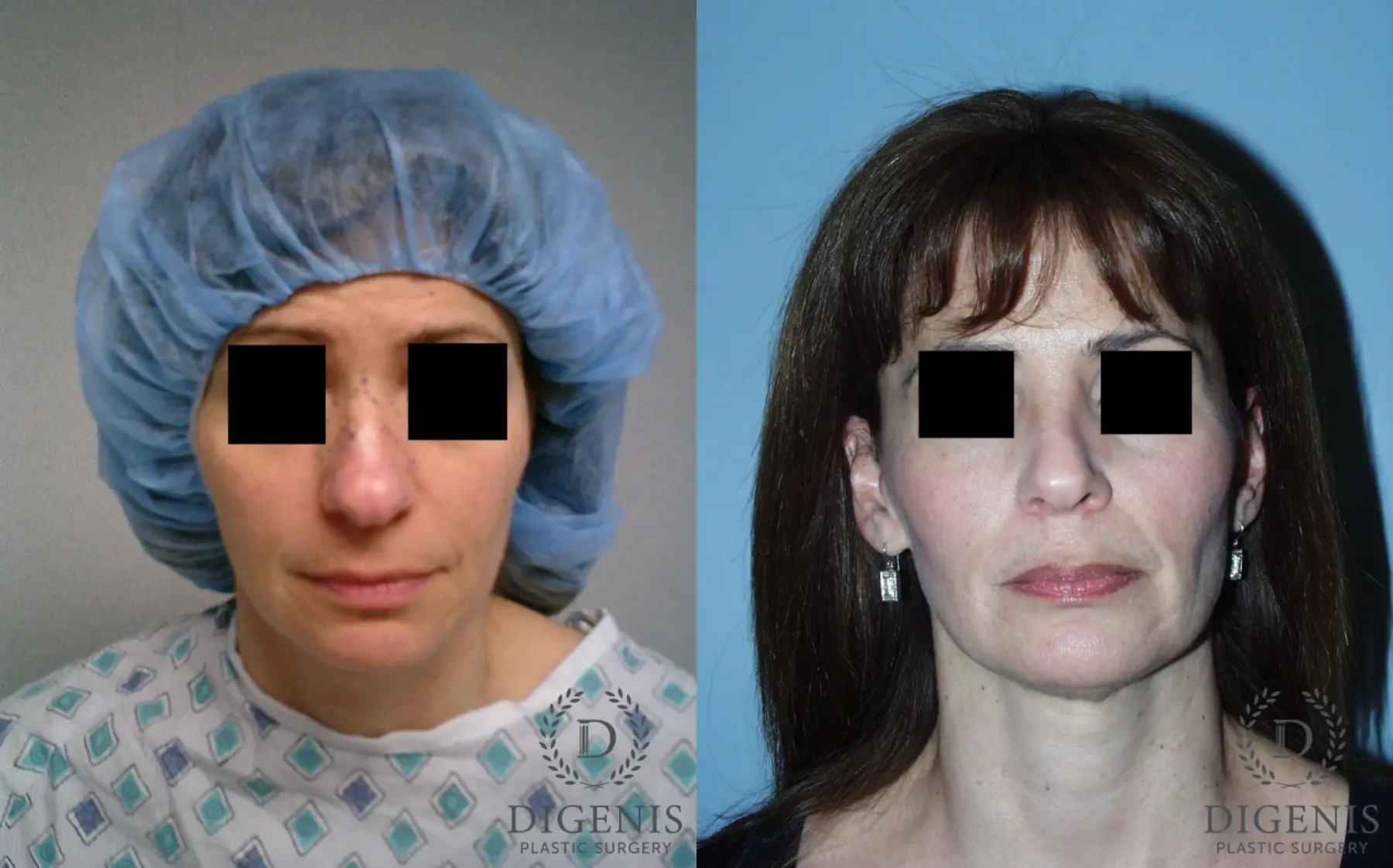 Rhinoplasty: Patient 5 - Before and After  