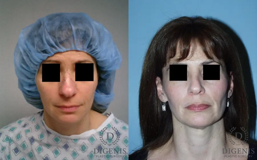 Rhinoplasty: Patient 5 - Before and After 1