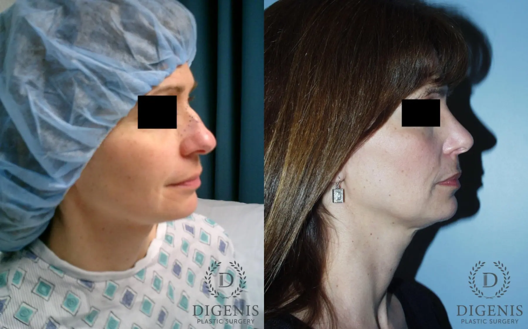 Rhinoplasty: Patient 5 - Before and After 3