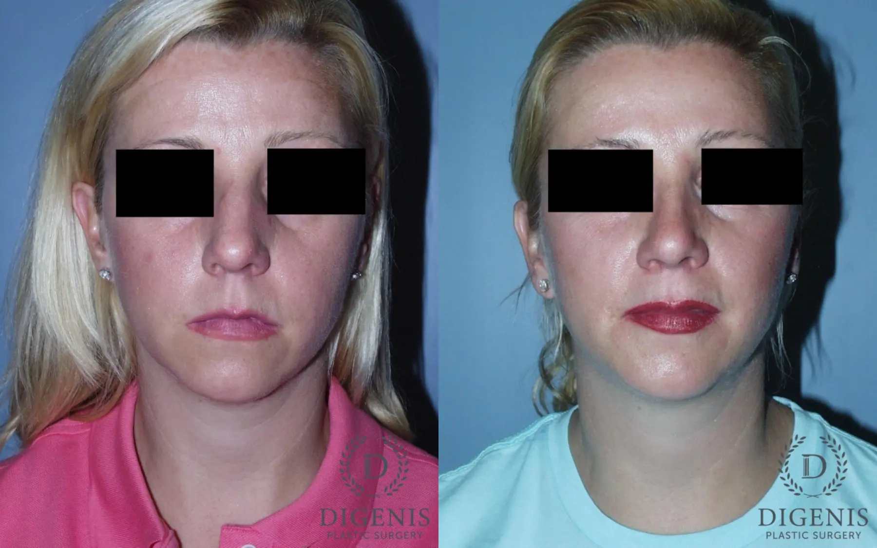 Rhinoplasty: Patient 3 - Before and After  