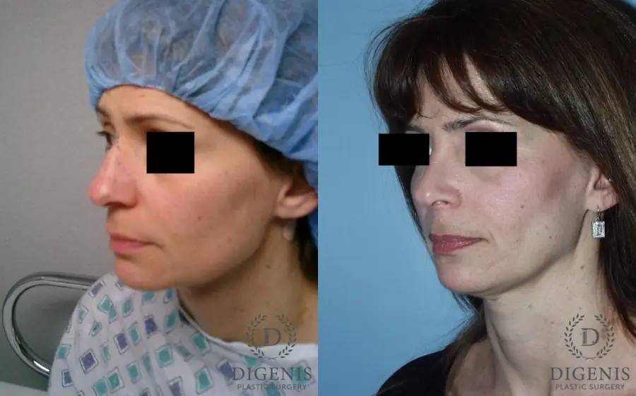Rhinoplasty: Patient 5 - Before and After 4