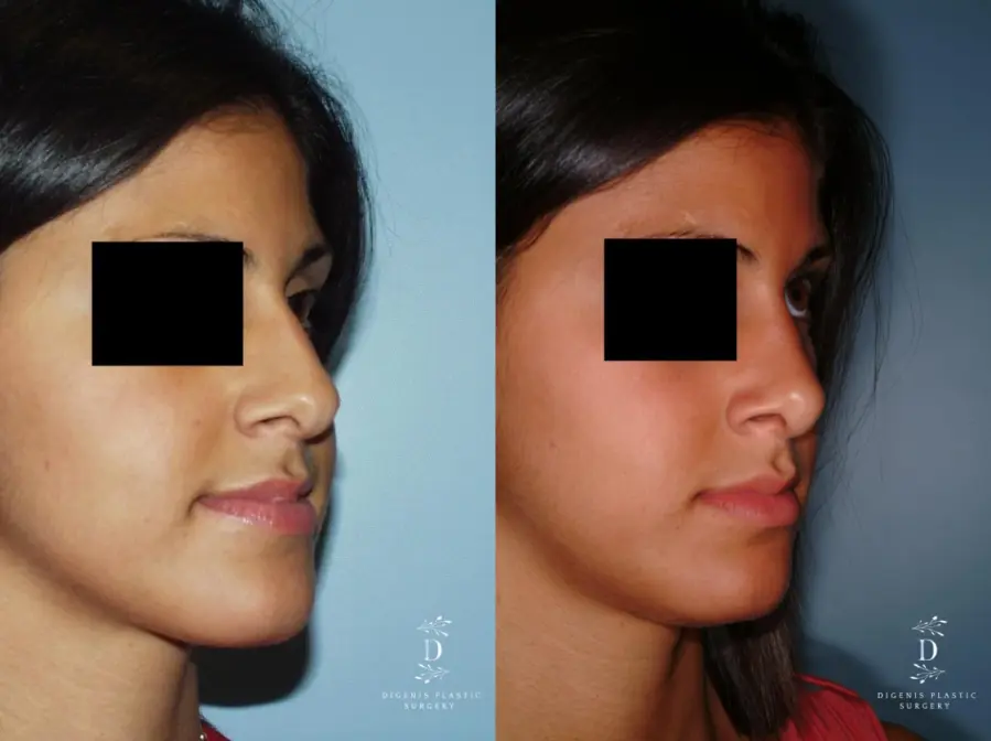 Rhinoplasty: Patient 8 - Before and After  