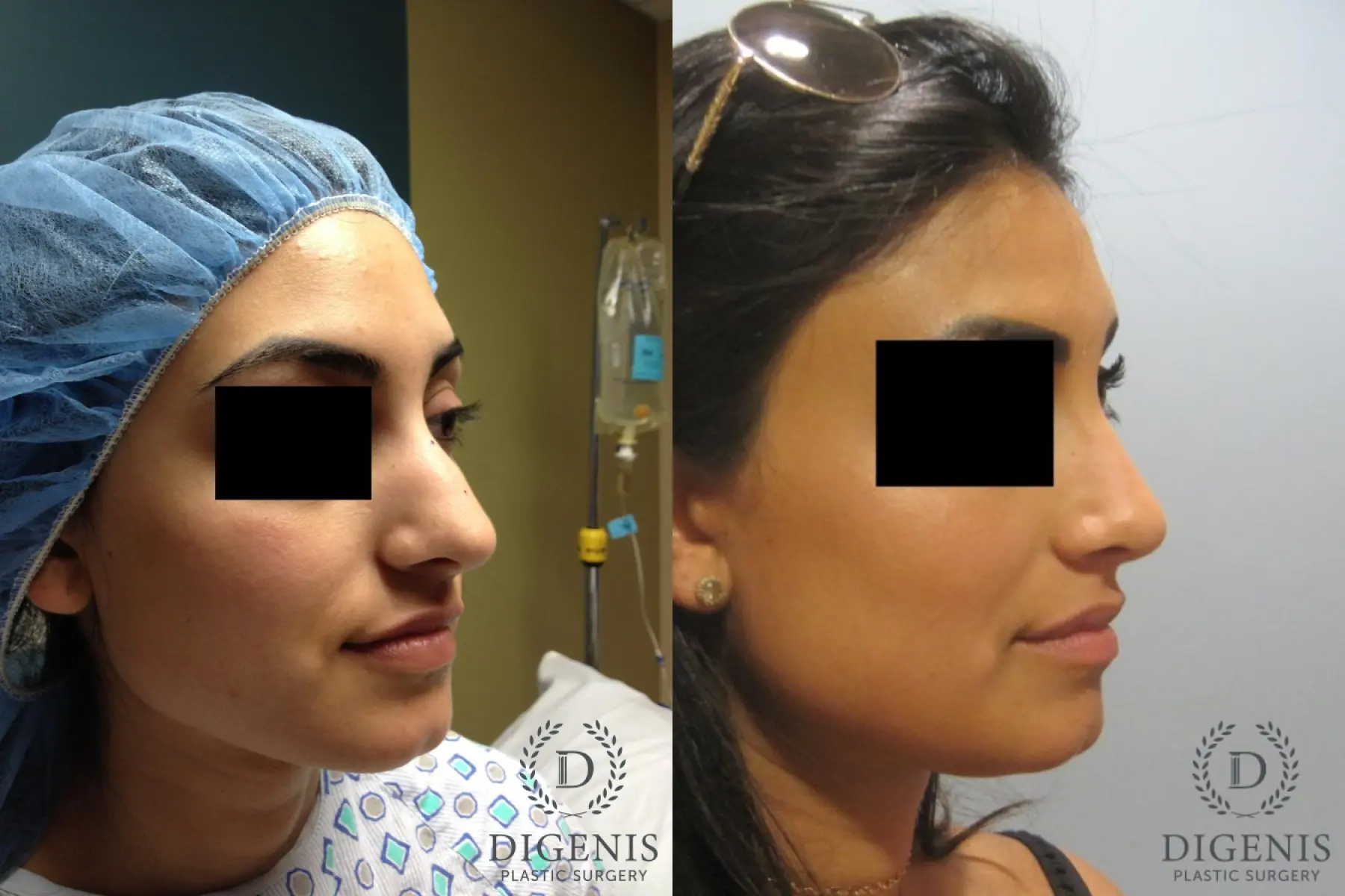 Rhinoplasty: Patient 7 - Before and After 2