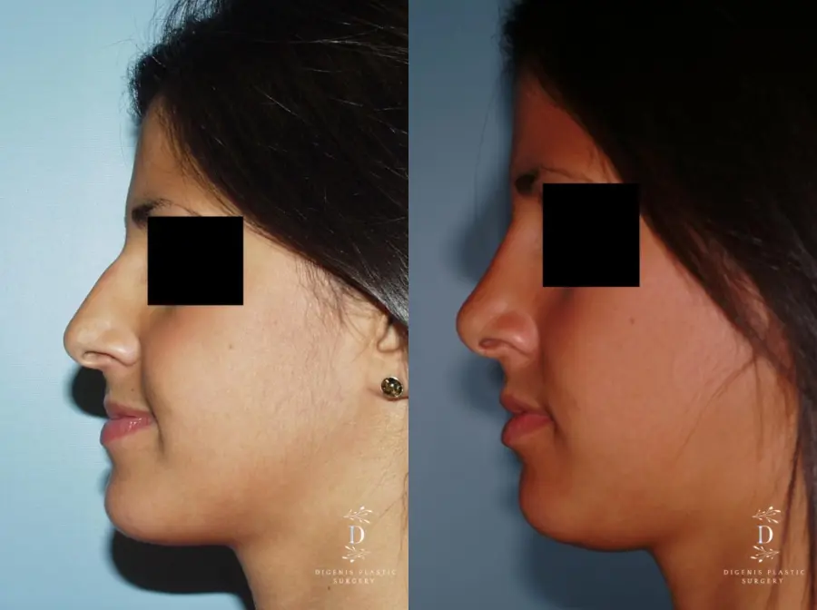 Rhinoplasty: Patient 8 - Before and After 4