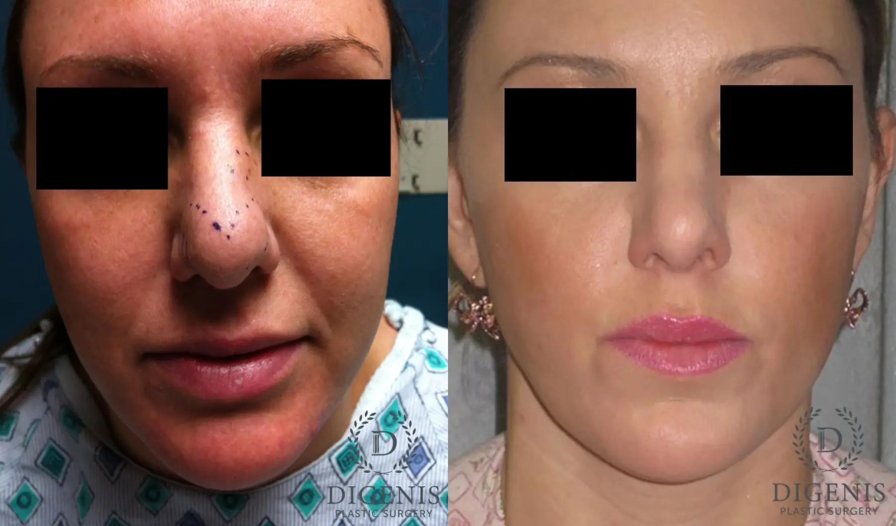 Rhinoplasty: Patient 1 - Before and After  