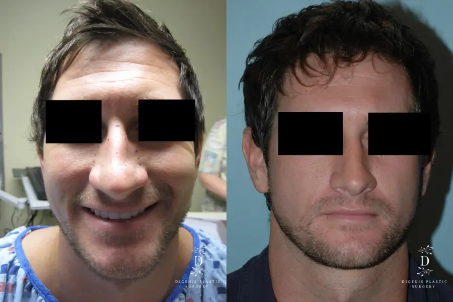 Rhinoplasty: Patient 10 - Before and After  