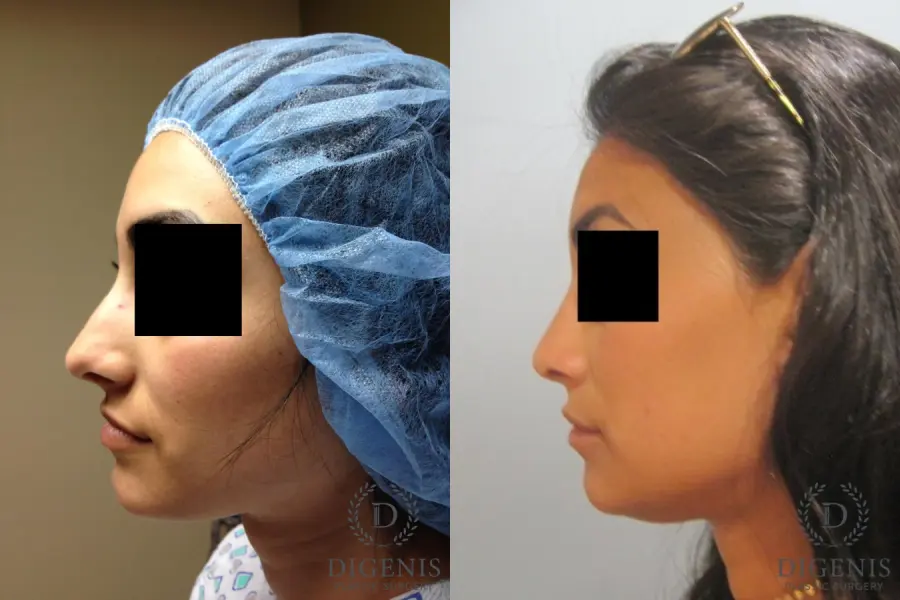 Rhinoplasty: Patient 7 - Before and After 5
