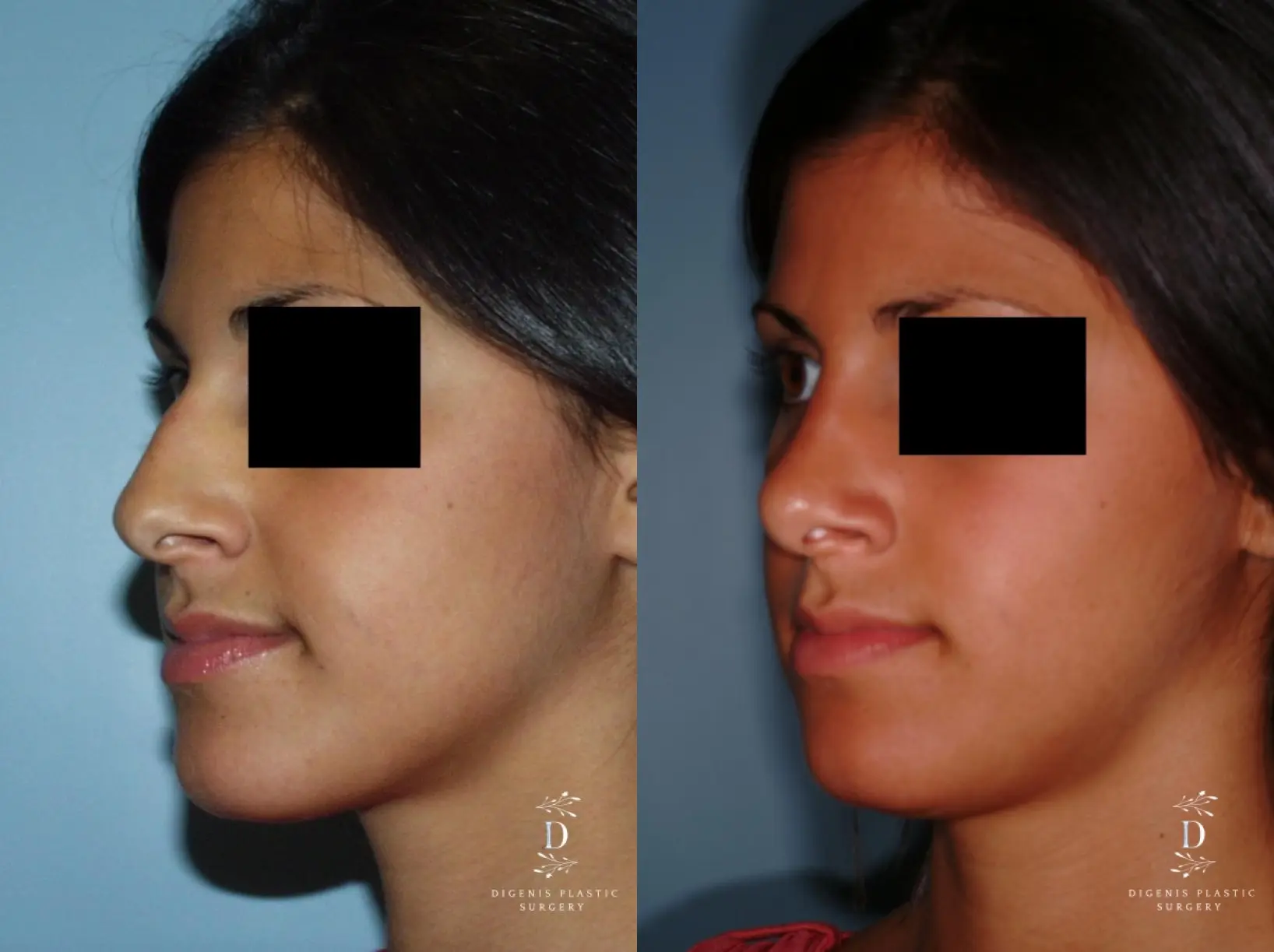 Rhinoplasty: Patient 8 - Before and After 3