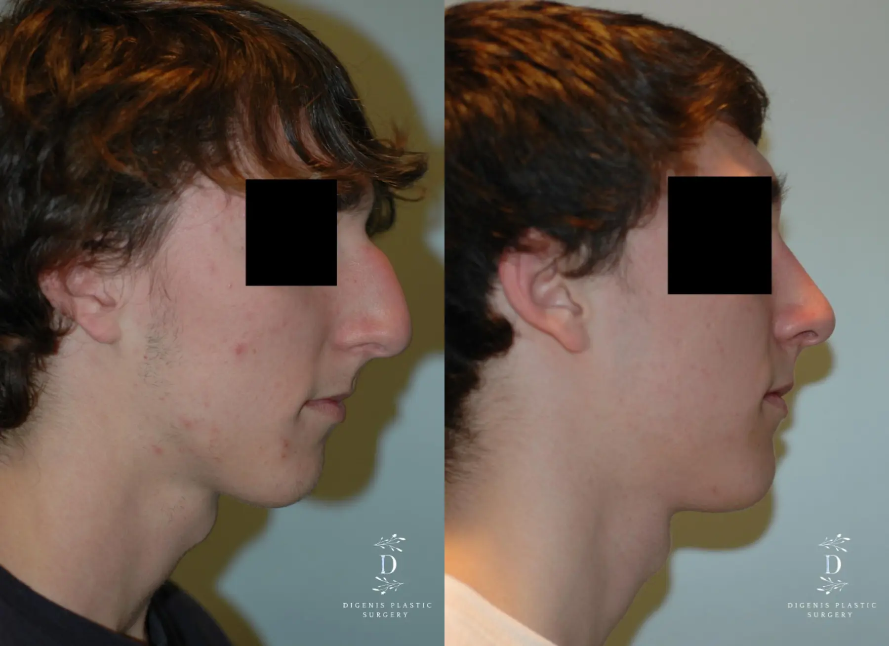 Rhinoplasty: Patient 9 - Before and After 3