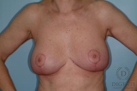 Breast Lift With Implants: Patient 6 - After 1