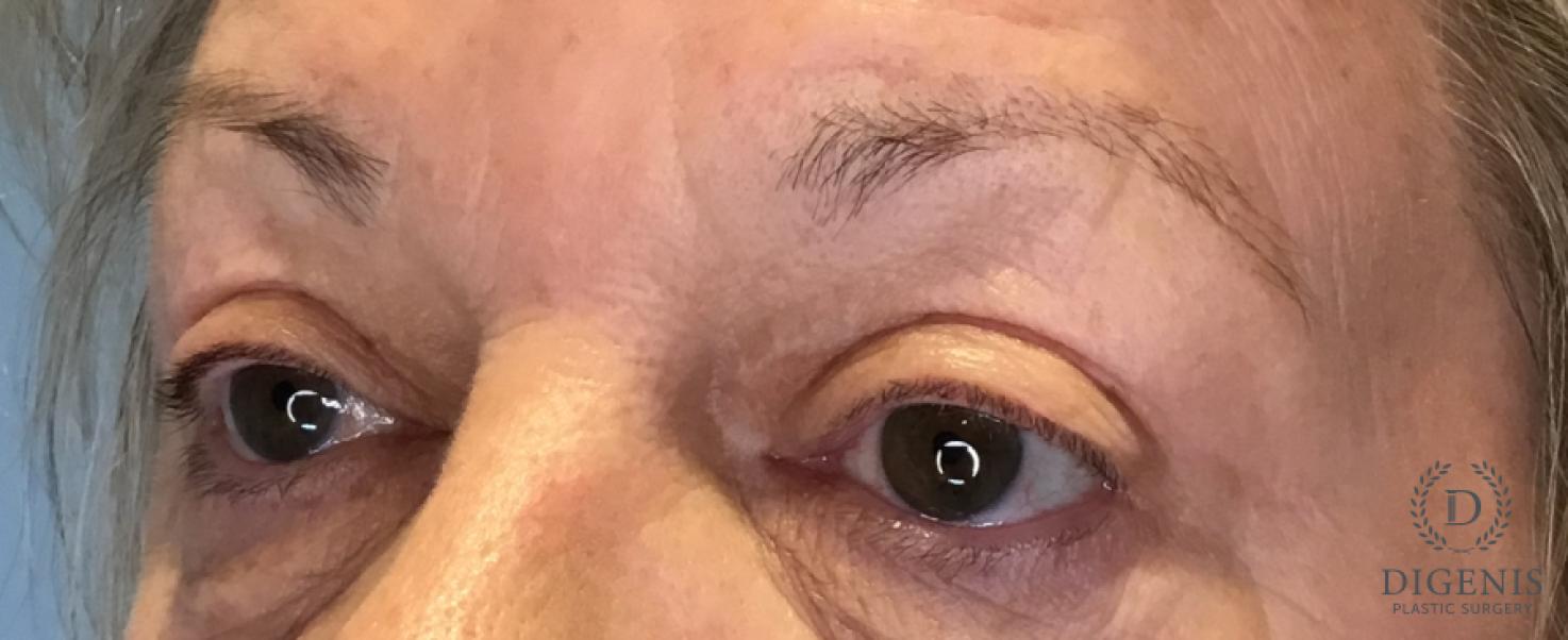 Eyelid Surgery: Patient 77 - After 4