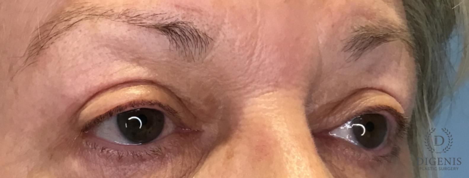 Eyelid Surgery: Patient 77 - After 2
