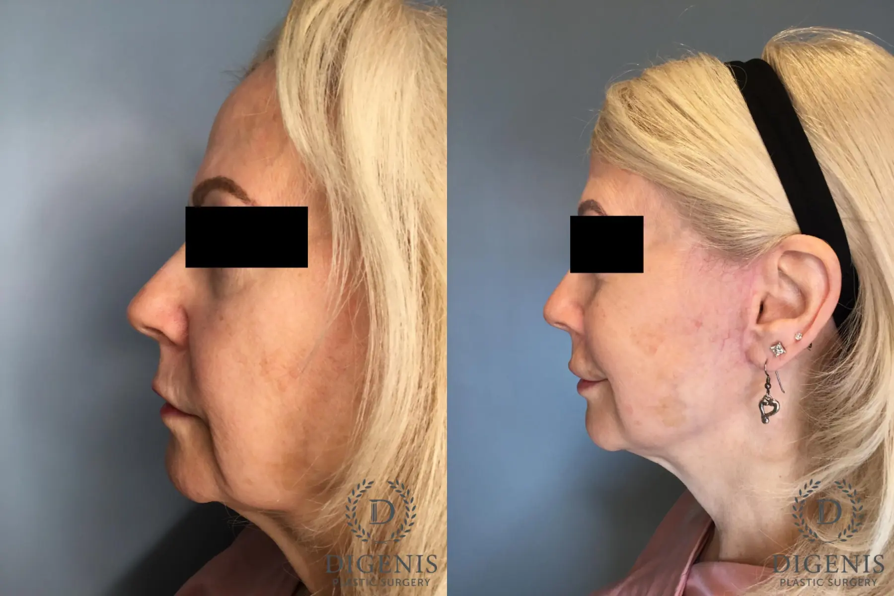 Temple Lift: Patient 1 - Before and After 3