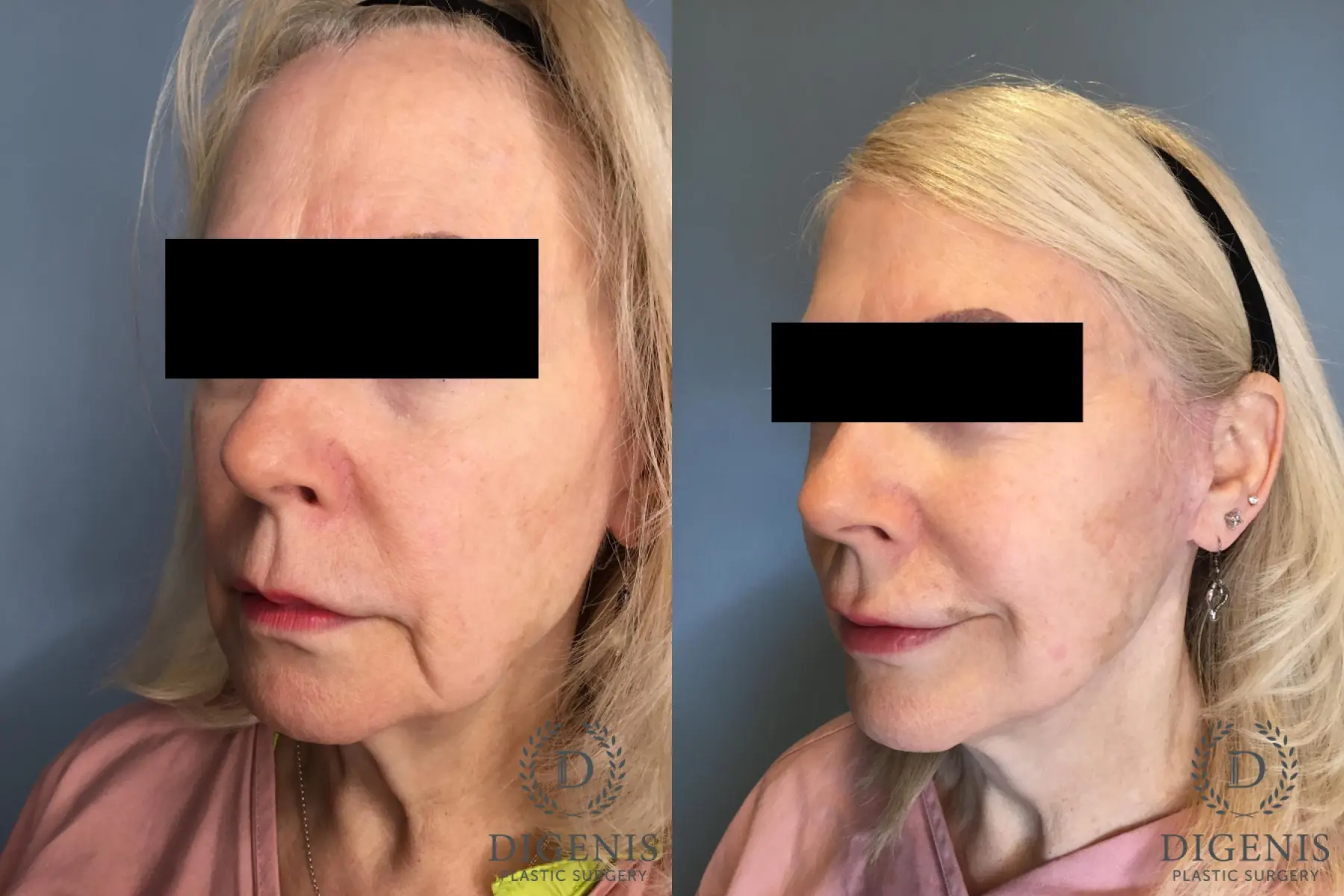 Temple Lift: Patient 1 - Before and After 2