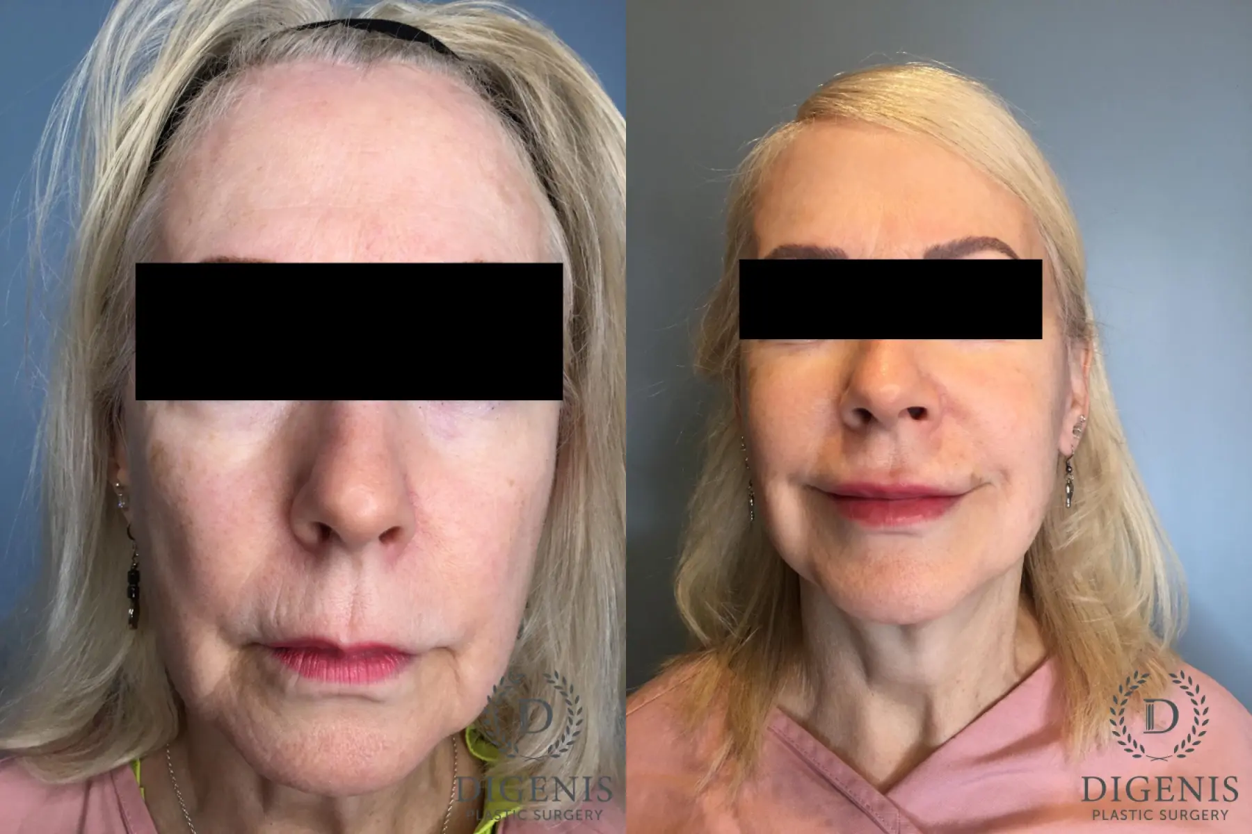 Temple Lift: Patient 1 - Before and After  