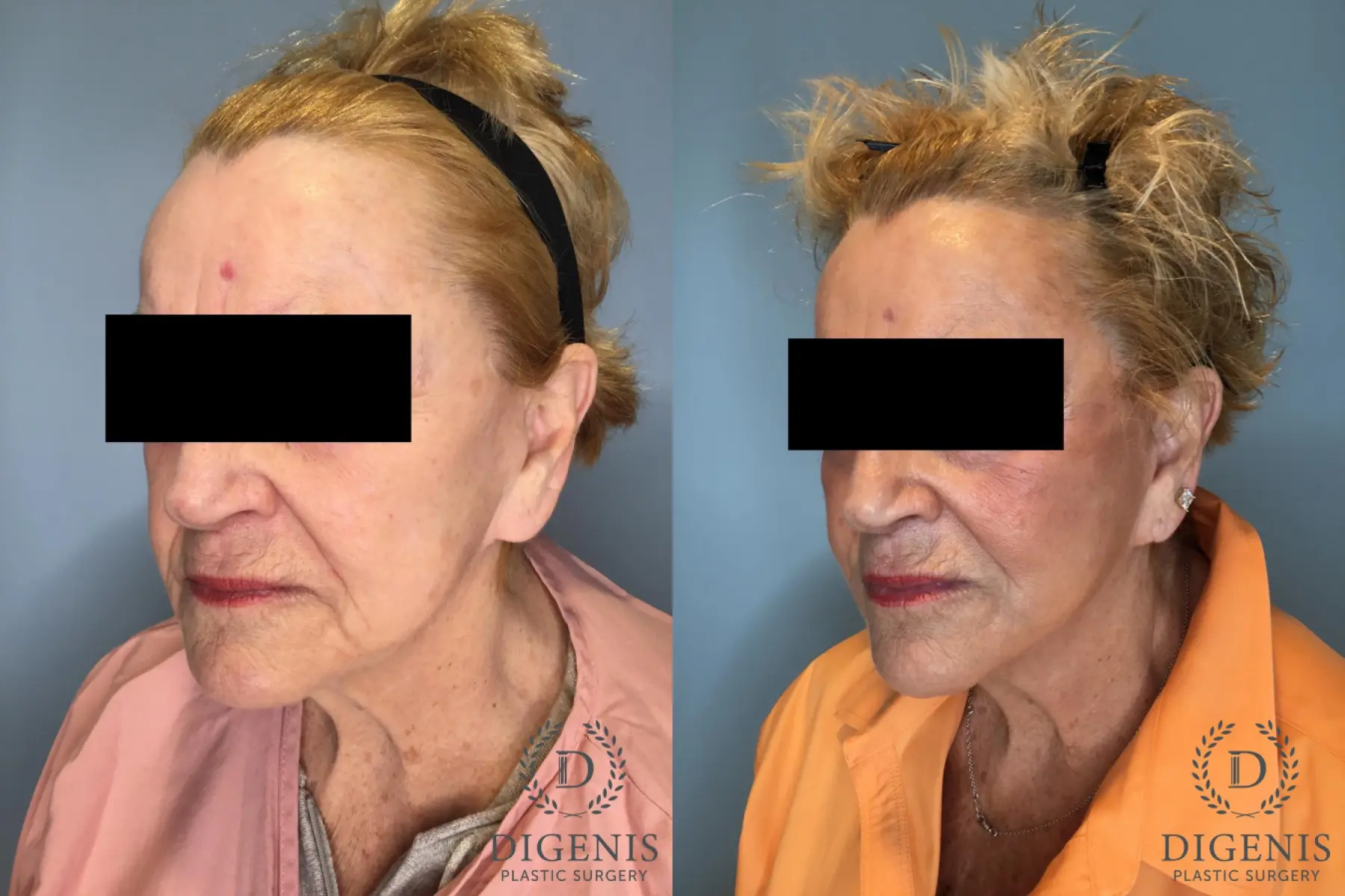 Temple Lift: Patient 2 - Before and After 4