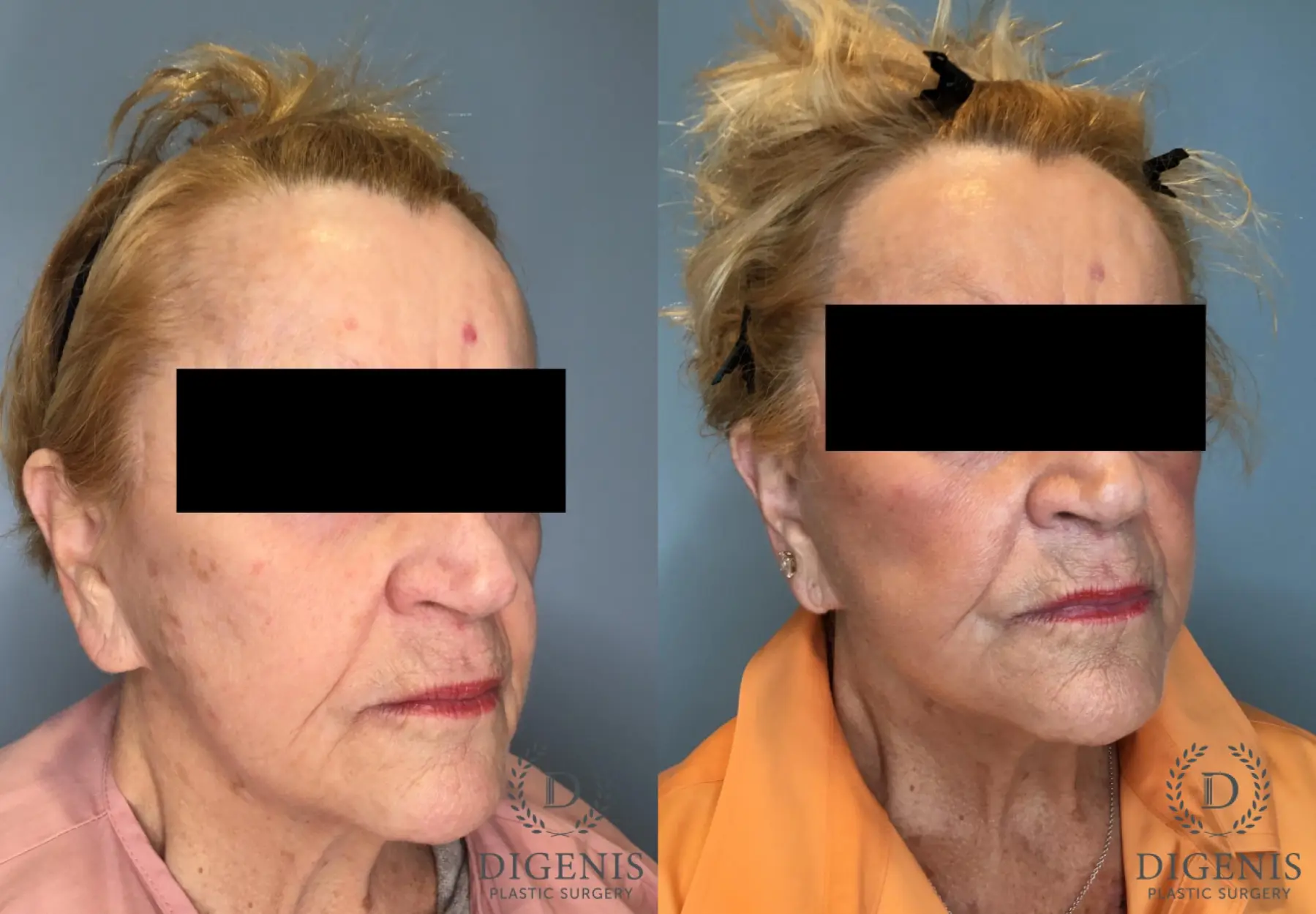 Temple Lift: Patient 2 - Before and After 2