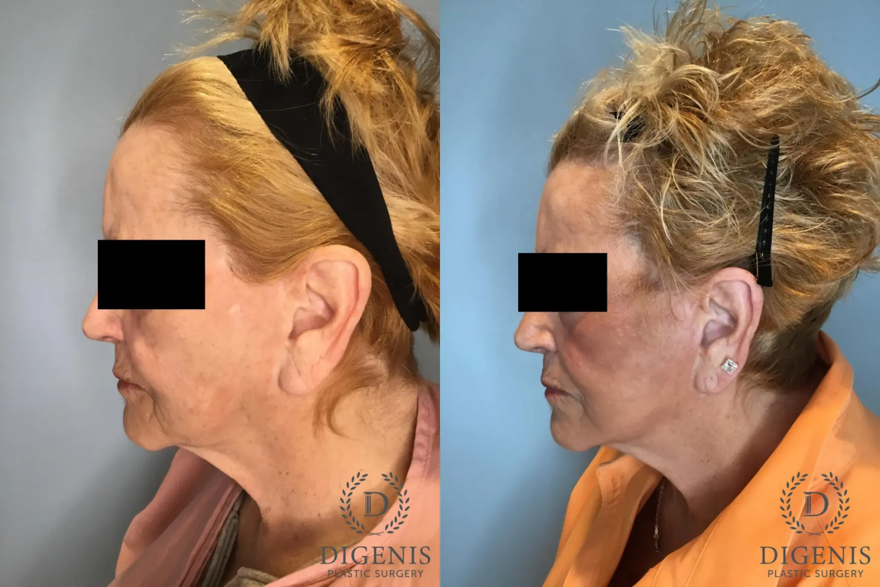 Temple Lift: Patient 2 - Before and After 5