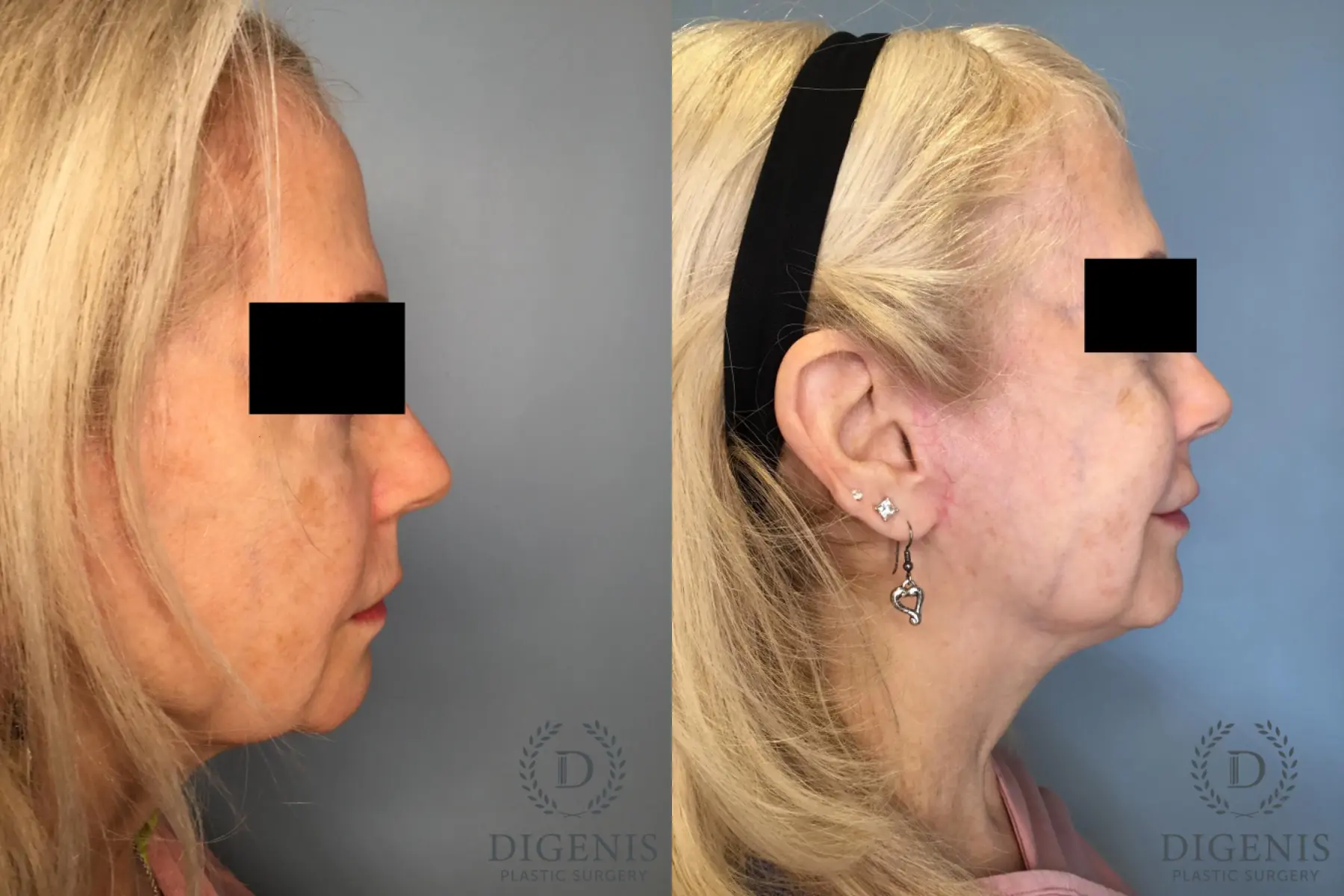 Temple Lift: Patient 1 - Before and After 5