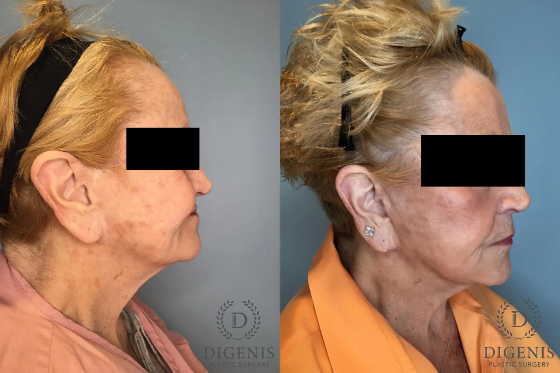 Temple Lift: Patient 2 - Before and After 3