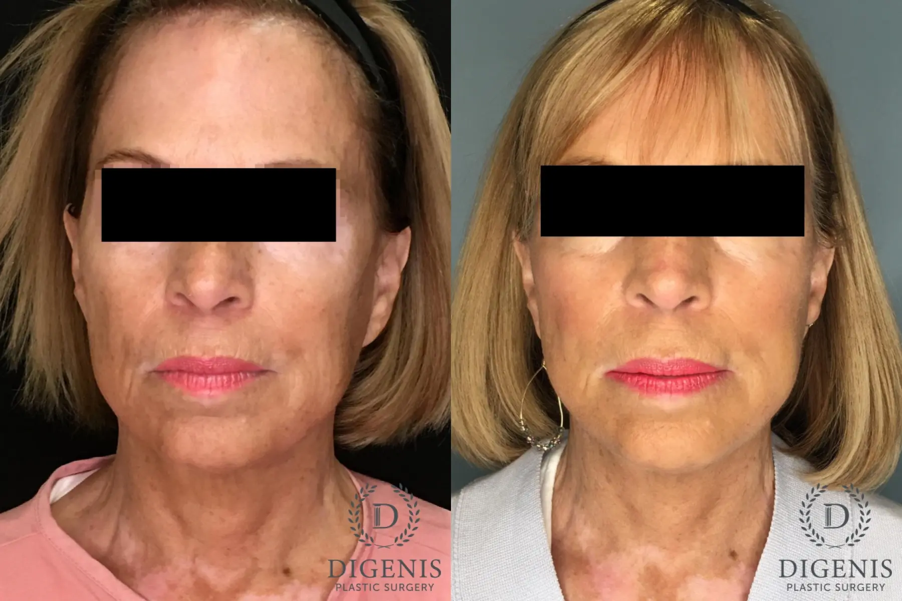 Temple Lift: Patient 3 - Before and After  